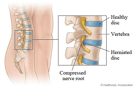 thoát vị đĩa đệm cột sống thắt lưng
