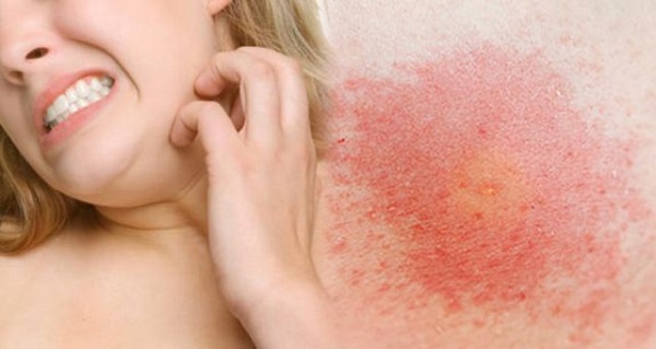 Biểu hiện viêm da dị ứng